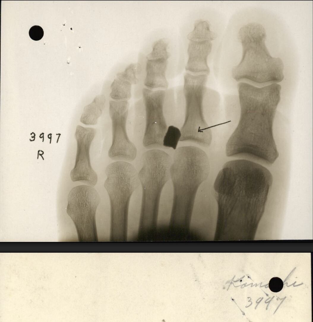 default-501 An X-ray from retired Private Otoji Kamachi's military records showing shrapnel in his foot from World War I.